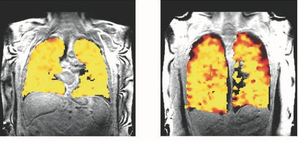 Scientists develop scan that unravels secrets of lung function