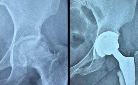 Gujarat: Ahmedabad Civil Hospital performs high-risk hip replacement on woman with serious blood disorder